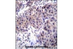 DVL3 Antibody (C-term) (ABIN655969 and ABIN2845354) immunohistochemistry analysis in formalin fixed and paraffin embedded human breast carcinoma followed by peroxidase conjugation of the secondary antibody and DAB staining. (DVL3 anticorps  (C-Term))