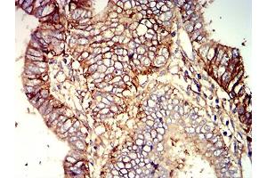 Immunohistochemical analysis of paraffin-embedded endometrial cancer tissues using B7H3 mouse mAb with DAB staining.