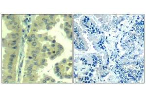 Immunohistochemical analysis of paraffin-embedded human lung carcinoma tissue using eIF4G(Ab-1232) Antibody(left) or the same antibody preincubated with blocking peptide(right).
