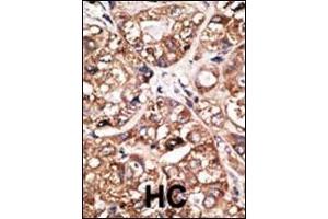 Formalin-fixed and paraffin-embedded human cancer tissue reacted with the primary antibody, which was peroxidase-conjugated to the secondary antibody, followed by DAB staining.