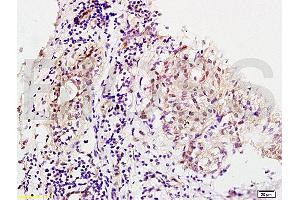 Formalin-fixed and human breast carcinoma tissue labeled with Anti-MMS19 Polyclonal Antibody, Unconjugated (ABIN1387802) at 1:200 followed by conjugation to the secondary antibody and DAB staining (MMS19 anticorps  (AA 851-950))