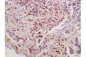 Formalin-fixed and paraffin embedded human colon carcinoma labeled with Anti-Cyclin B1 Polyclonal Antibody, Unconjugated (ABIN670296) at 1:200 followed by conjugation to the secondary antibody and DAB staining