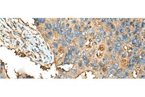 Immunohistochemistry of paraffin-embedded Human colorectal cancer tissue using CEACAM8 Polyclonal Antibody at dilution of 1:30(x200) (CEACAM8 anticorps)