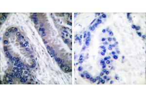 Cl-peptide - +Immunohistochemical analysis of paraffin-embedded human lung carcinoma tissue, using Caspase 1 (Cleaved-Asp210) antibody. (Caspase 1 anticorps  (Cleaved-Asp210))