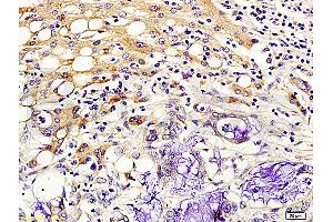 Formalin-fixed and paraffin embedded human colon cancer labeled with Rabbit Anti-Kiss 1/Kisspeptin Polyclonal Antibody (ABIN672726), Unconjugated 1:200 followed by conjugation to the secondary antibody and DAB staining. (KISS1 anticorps  (AA 81-145))