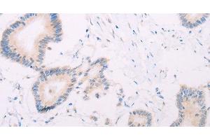 Immunohistochemistry of paraffin-embedded Human colon cancer tissue using MAP3K12 Polyclonal Antibody at dilution 1:30 (MAP3K12 anticorps)
