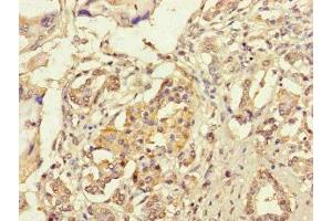 Immunohistochemistry of paraffin-embedded human pancreatic cancer using ABIN7167005 at dilution of 1:100