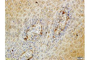 Formalin-fixed and paraffin embedded human endometrium carcinoma labeled with Rabbit Anti-Matriptase Polyclonal Antibody (ABIN669726), Unconjugated at 1:100 followed by conjugation to the secondary antibody and DAB staining.