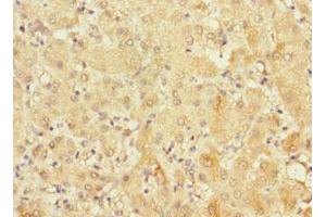 Immunohistochemistry of paraffin-embedded human liver cancer using ABIN7152685 at dilution of 1:100 (FRMD6 anticorps  (AA 413-622))