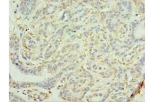 Immunohistochemistry of paraffin-embedded human breast cancer using ABIN7159289 at dilution of 1:100 (MAGEC2 anticorps  (AA 1-150))