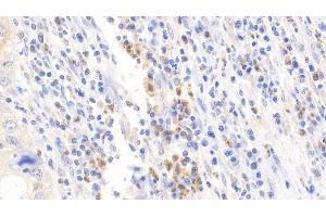 Detection of DPP3 in Human Lymphoma Tissue using Polyclonal Antibody to Dipeptidyl Peptidase 3 (DPP3)