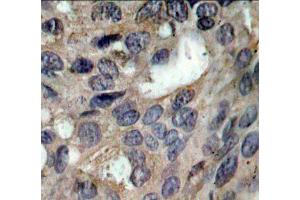 Immunohistochemistry of paraffin-embedded human breast carcinoma using Phospho-SRC-Y529 antibody (ABIN5969948). (Src anticorps  (pTyr529))