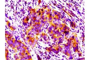 IHC image of ABIN7165944 diluted at 1:100 and staining in paraffin-embedded human pancreatic cancer performed on a Leica BondTM system. (PPM1F anticorps  (AA 1-76))