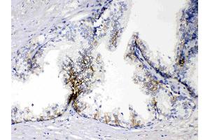 EPCAM was detected in paraffin-embedded sections of human prostatic cancer tissues using rabbit anti- EPCAM Antigen Affinity purified polyclonal antibody (Catalog # ) at 1 µg/mL.