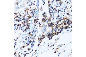 Immunohistochemistry of paraffin-embedded human lung cancer using SPN antibody.