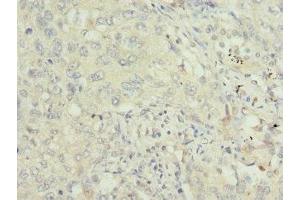 Immunohistochemistry of paraffin-embedded human lung cancer using ABIN7172240 at dilution of 1:100 (TRAF4 anticorps  (AA 251-470))