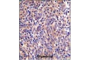 THEMIS Antibody (C-term) (ABIN655135 and ABIN2844761) immunohistochemistry analysis in formalin fixed and paraffin embedded human thymoma followed by peroxidase conjugation of the secondary antibody and DAB staining. (THEMIS anticorps  (C-Term))