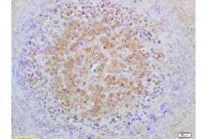 Formalin-fixed and paraffin embedded mouse lymphoma labeled with Anti-Smad3 Polyclonal Antibody, Unconjugated  at 1:200 followed by conjugation to the secondary antibody and DAB staining (Smad2/3 anticorps  (AA 30-80))
