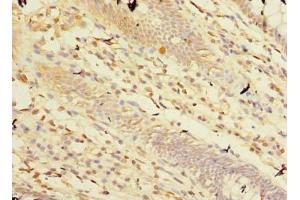 Immunohistochemistry of paraffin-embedded human colon cancer using ABIN7146760 at dilution of 1:100 (Carboxypeptidase A2 anticorps  (AA 115-419))