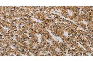 Immunohistochemistry of paraffin-embedded Human prostate cancer using BRAF Polyclonal Antibody at dilution of 1:30 (BRAF anticorps)
