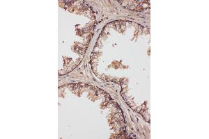 Anti-LCN1 antibody,IHC(P) IHC(P): Human Prostatic Cancer Tissue