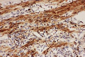 Anti-COX1 Picoband antibody,  IHC(P): Human Intestinal Cancer Tissue
