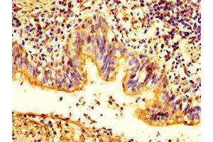 IHC image of ABIN7163503 diluted at 1:200 and staining in paraffin-embedded human lung cancer performed on a Leica BondTM system. (Plakophilin 2 anticorps  (AA 61-183))