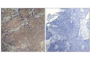 Immunohistochemical analysis of paraffin-embedded human breast carcinoma tissue using Myosin Light Chain 2 (Phospho-Ser19) Antibody (left) or the same antibody preincubated with blocking peptide (right).