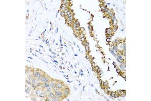 Immunohistochemistry of paraffin-embedded human lung cancer using DFNA5 antibody. (DFNA5 anticorps)