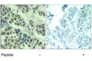 Immunohistochemical analysis of paraffin-embedded human breast carcinoma tissue using MDM2 polyclonal antibody . (MDM2 anticorps  (Ser166))