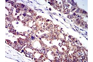 Immunohistochemical analysis of paraffin-embedded ovarian cancer tissues using CD129 mouse mAb with DAB staining.