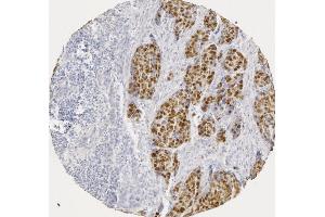 p53 staining in human squamous cell carcinoma (image courtesy of J.