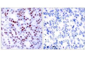 Immunohistochemical analysis of paraffin-embedded human breast carcinoma tissue using c-Jun (Ab-243) antibody (E021025). (C-JUN anticorps)