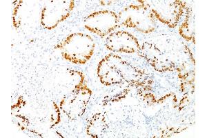 Formalin-fixed, paraffin-embedded human Lung Adenocarcinoma stained with TTF-1 Mouse Monoclonal Antibody (8G7G3/1). (NKX2-1 anticorps)