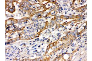 Alpha Actinin 4 was detected in paraffin-embedded sections of human intestinal  cancer tissues using rabbit anti- Alpha Actinin 4 Antigen Affinity purified polyclonal antibody (Catalog # ) at 1 µg/mL.