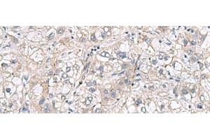 Immunohistochemistry of paraffin-embedded Human liver cancer tissue using RNF208 Polyclonal Antibody at dilution of 1:65(x200) (RNF208 anticorps)