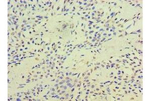 Immunohistochemistry of paraffin-embedded human breast cancer using ABIN7171737 at dilution of 1:100 (RAP1 anticorps  (AA 1-280))
