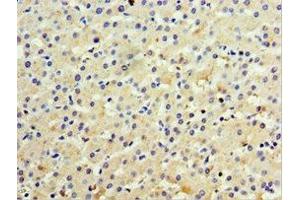Immunohistochemistry of paraffin-embedded human liver cancer using ABIN7156612 at dilution of 1:100 (IL28B anticorps  (AA 22-196))