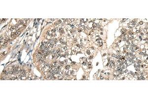 Immunohistochemistry of paraffin-embedded Human gastric cancer tissue using MCPH1 Polyclonal Antibody at dilution of 1:110(x200) (MCPH1 anticorps)