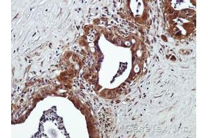 IHC-P Image Immunohistochemical analysis of paraffin-embedded Human prostate adenocarcinoma, using GPR120 , antibody at 1:500 dilution.