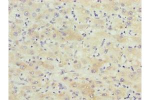 Immunohistochemistry of paraffin-embedded human liver cancer using ABIN7145848 at dilution of 1:100 (KCTD19 anticorps  (AA 490-751))