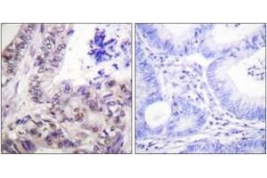 Immunohistochemistry analysis of paraffin-embedded human colon carcinoma, using Caspase 9 (Phospho-Ser144) Antibody. (Caspase 9 anticorps  (pSer144))
