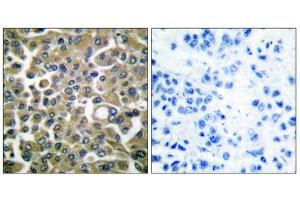 Immunohistochemical analysis of paraffin-embedded human breast carcinoma tissue using Keratin 16 antibody (ABIN5976436). (KRT16 anticorps  (C-Term))