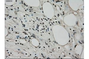Immunohistochemical staining of paraffin-embedded Adenocarcinoma of ovary tissue using anti-BUB1Bmouse monoclonal antibody. (BUB1B anticorps)