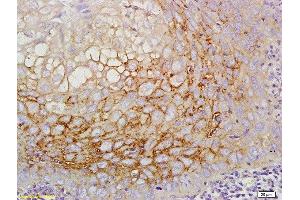 Formalin-fixed and paraffin embedded human laryngeal cancer labeled with Anti-CD44v5 Polyclonal Antibody, Unconjugated  at 1:200 followed by conjugation to the secondary antibody (CD44RC (AA 61-139) anticorps)