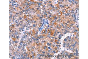 Immunohistochemistry of Human thyroid cancer using ELP2 Polyclonal Antibody at dilution of 1:40