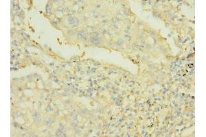 Immunohistochemistry of paraffin-embedded human lung cancer using ABIN7167504 at dilution of 1:100