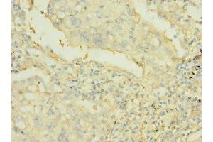 Immunohistochemistry of paraffin-embedded human lung cancer using ABIN7167504 at dilution of 1:100 (PTPRJ anticorps  (AA 140-370))