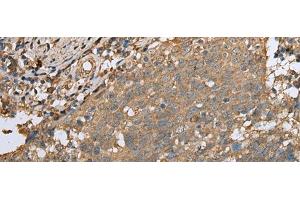 Immunohistochemistry of paraffin-embedded Human cervical cancer tissue using ALKBH8 Polyclonal Antibody at dilution of 1:25(x200)