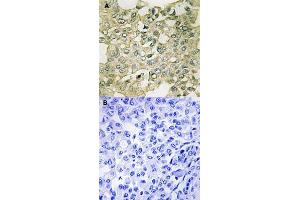 Immunohistochemical staining of human breast carcinoma tissue by PKMYT1 (phospho S83) polyclonal antibody  without blocking peptide (A) or preincubated with blocking peptide (B) under 1:50-1:100 dilution. (PKMYT1 anticorps  (pSer83))